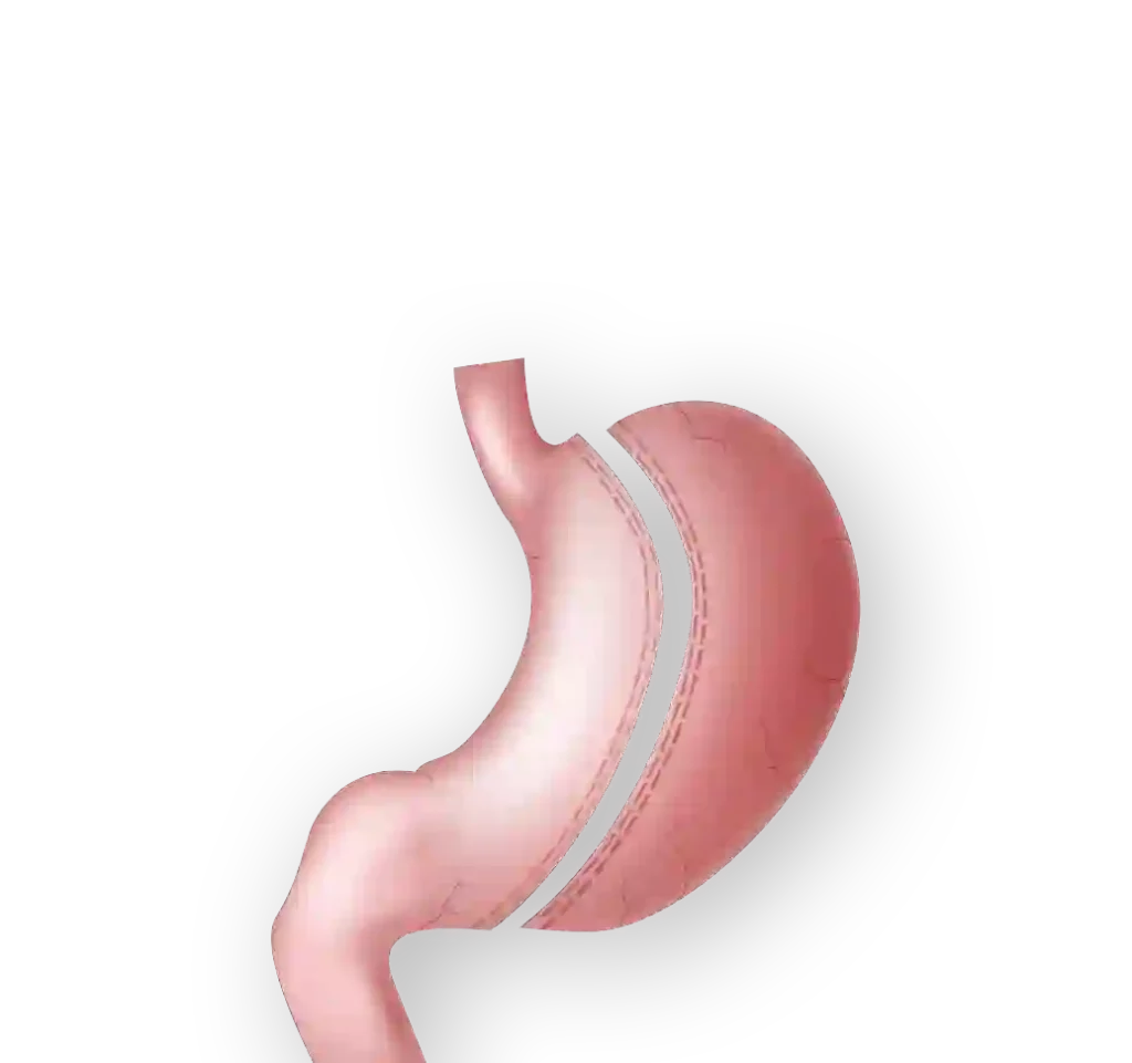 اسعار عملية تكميم المعدة