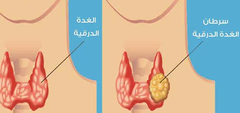 شكل الورم الحميد في الغدة الدرقية|هل يجب استئصال الورم الحميد في الغدة
