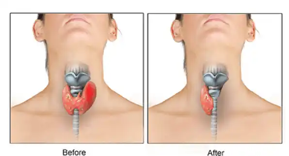 شكل الورم الحميد في الغدة الدرقية|هل يجب استئصال الورم الحميد في الغدة