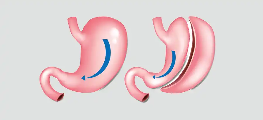 مخاطر عملية تكميم المعدة بالمنظار