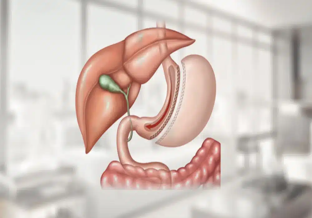 تمدد حجم المعدة بعد عمليات التكميم
