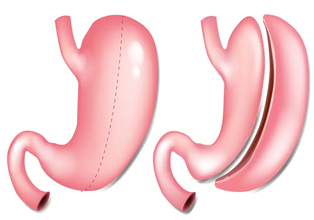 عملية بوتكس المعدة